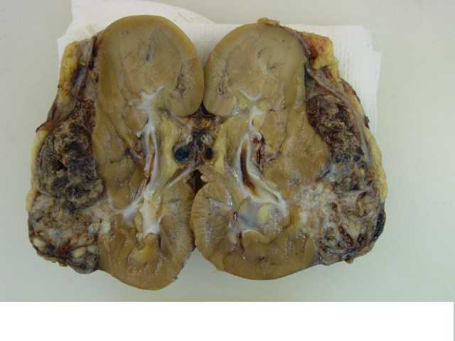 Fig.1 - Lesin de polo inferior renal que despega la cpsula.